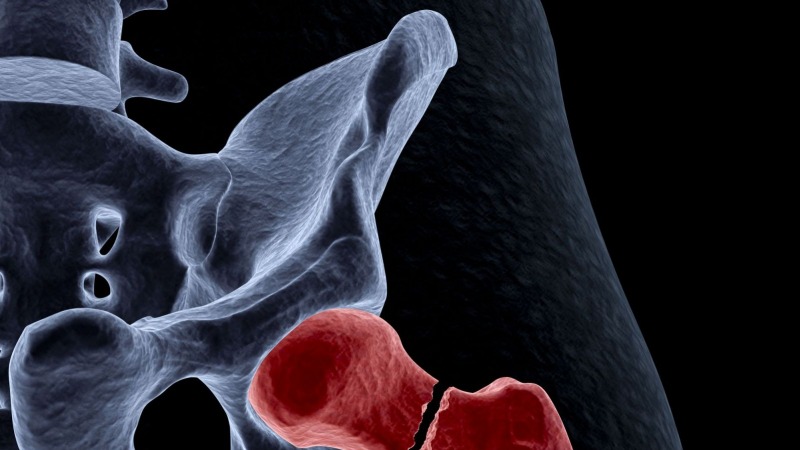 Alles, was man über Osteoporose wissen muss
